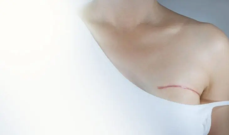 chirurgie du sein : mastectomie