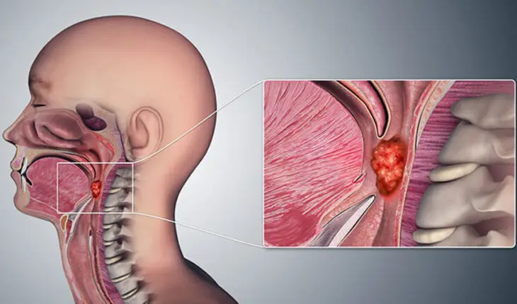 symptomes du cancer du nasopharynx