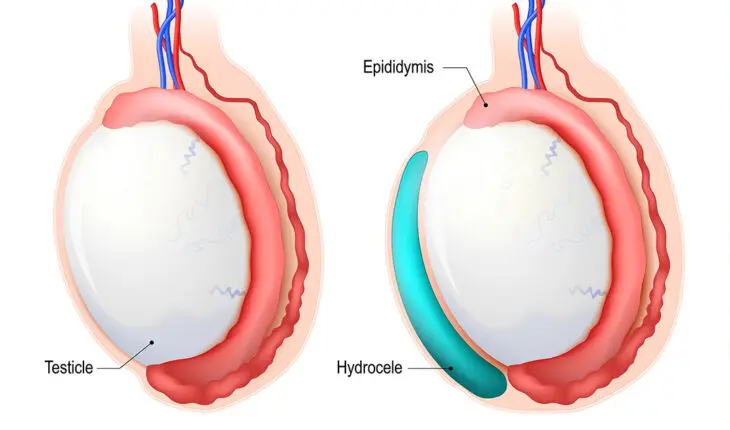 Hydrocèle testiculaire