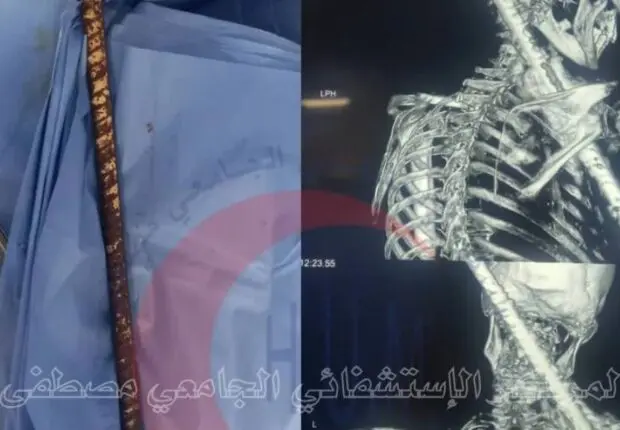 Miracle médical au CHU Mustapha Pacha : un ouvrier transpercé par une barre de fer sauvé de justesse