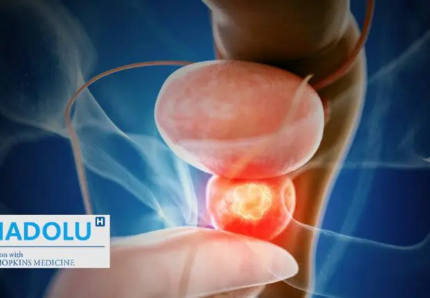Radiothérapie et cancer de la prostate : les dernières avancées qui changent la donne