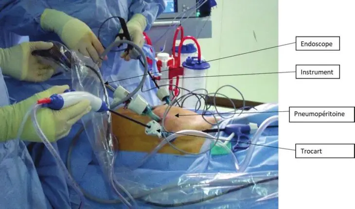 chirurgie laparoscopique