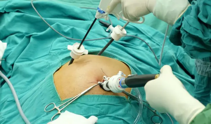 Chirurgie de la vésicule biliaire : cholecystectomie