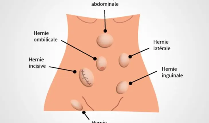 hernies-abdominales