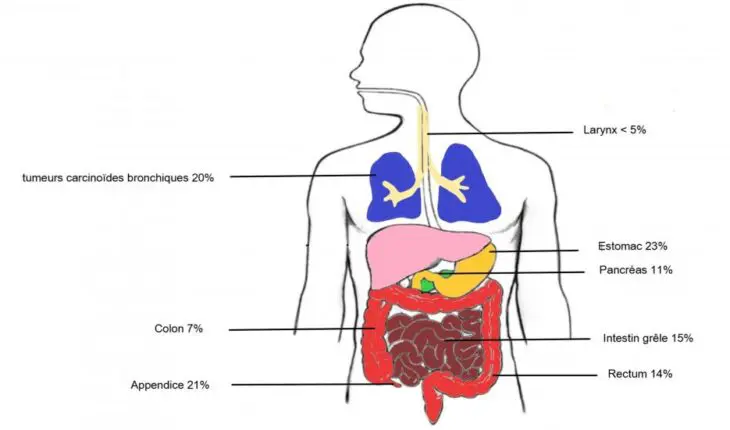 types de tumeurs neuroendocrines