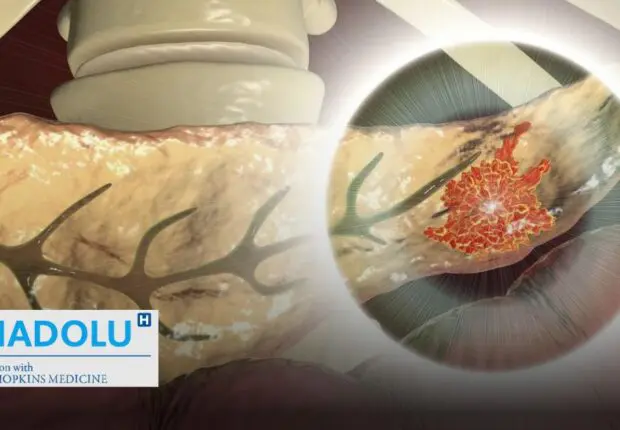 Traitement chirurgical des tumeurs neuroendocrines : techniques, suivi et perspectives