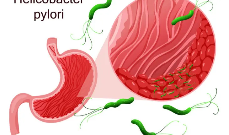 Helicobacter pylori et gastrite