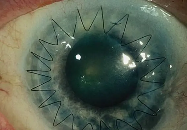 Greffes de la cornée à partir de donneurs décédés : bientôt une réalité en Algérie ?