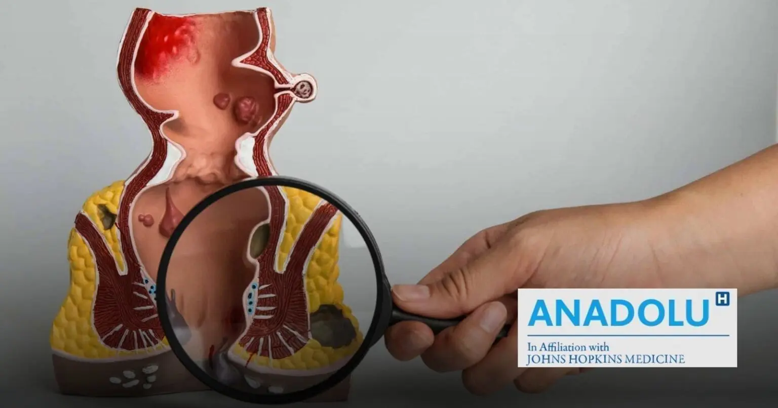 Démystifier les fissures anales : signes révélateurs et traitement efficaces