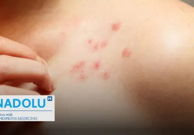 Qu’est-ce que le kyste hydatique : symptômes et options de traitement