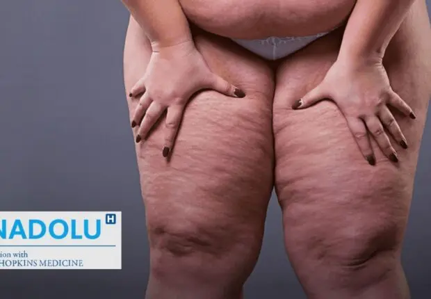Lipœdème : ne confondez pas ce trouble avec la cellulite ou l’obésité