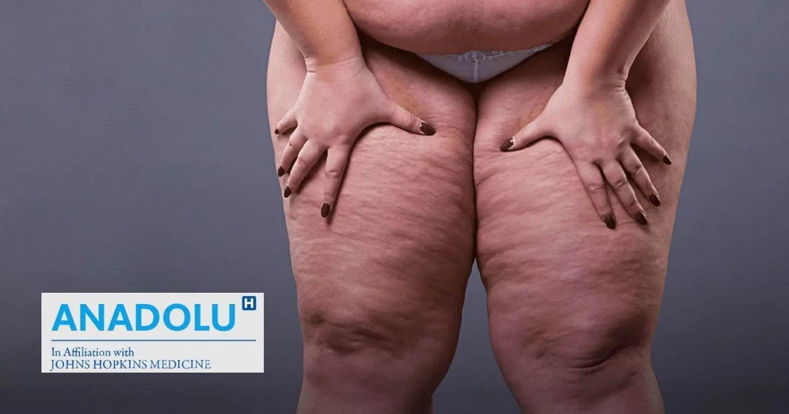 Lipœdème : ne confondez pas ce trouble avec la cellulite ou l’obésité