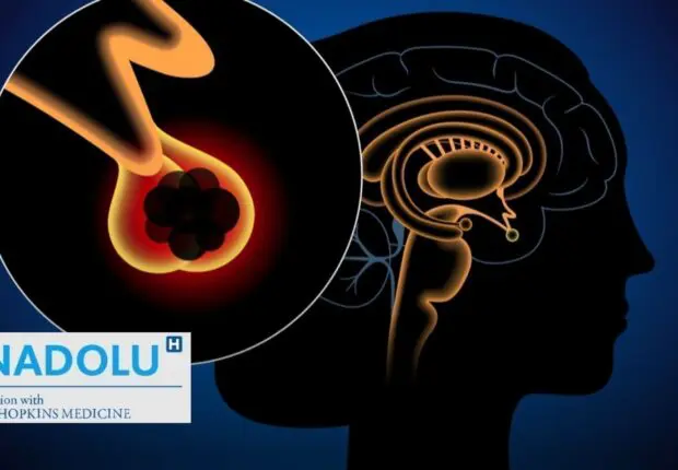Adénome hypophysaire : ce qu’il faut savoir sur ces tumeurs bénignes du cerveau