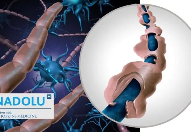 Sclérose en plaques (SEP) : causes, symptômes, évolution, traitement… le guide complet