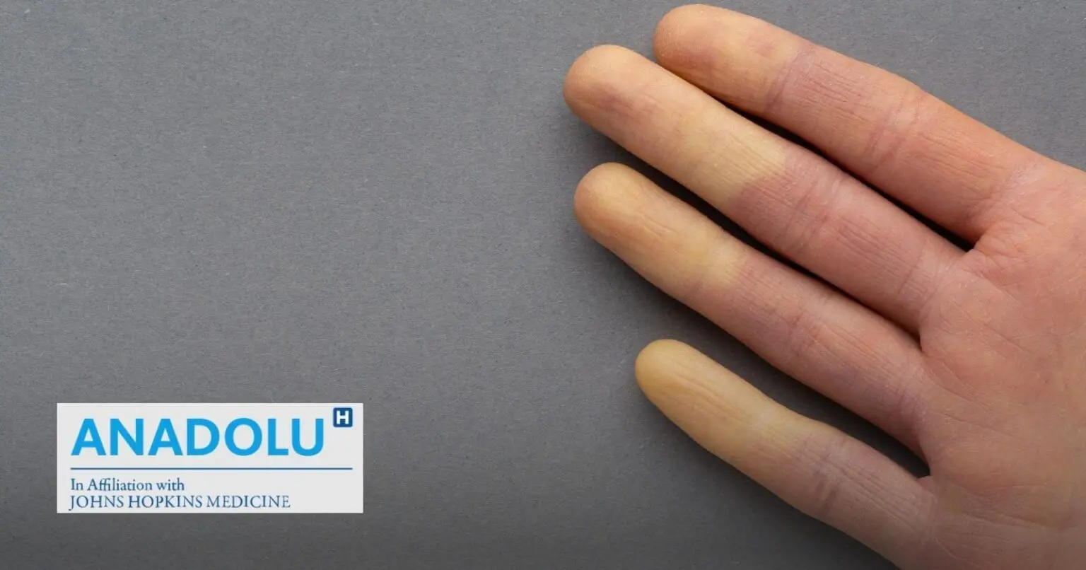 Mains et pieds toujours froids ? Attention, cela peut cacher la maladie de Raynaud