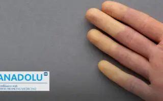 Mains et pieds toujours froids ? Attention, cela peut cacher la maladie de Raynaud