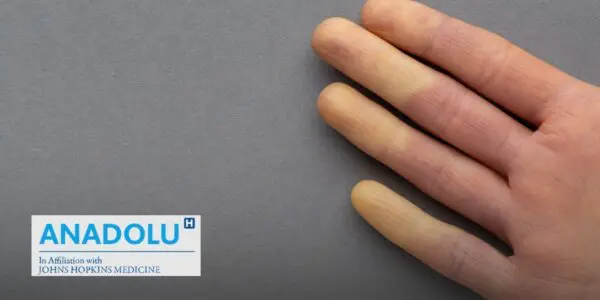 Mains et pieds toujours froids ? Attention, cela peut cacher la maladie de Raynaud