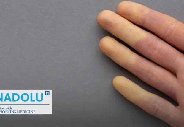 Mains et pieds toujours froids ? Attention, cela peut cacher la maladie de Raynaud