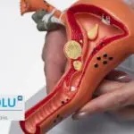 Syndrome des ovaires polykystiques (SOPK) : symptômes et solutions, le guide essentiel