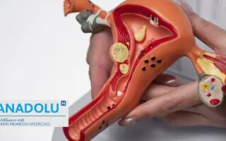 Syndrome des ovaires polykystiques (SOPK) : symptômes et solutions, le guide essentiel