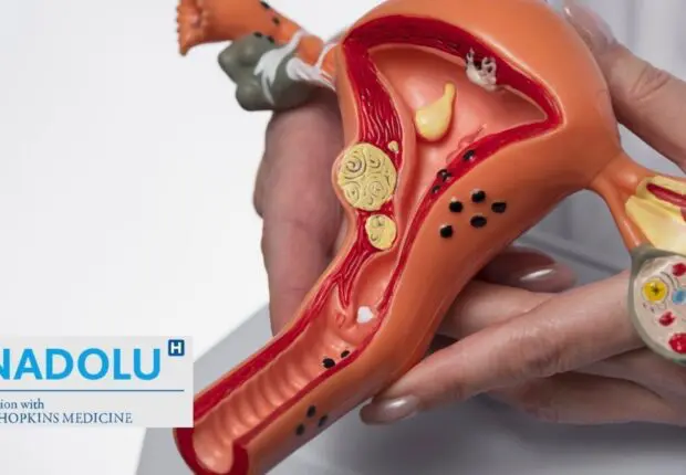 Syndrome des ovaires polykystiques (SOPK) : symptômes et solutions, le guide essentiel