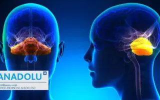 De la définition au traitement : tout savoir sur le syndrome cérébelleux (malformation de Chiari)