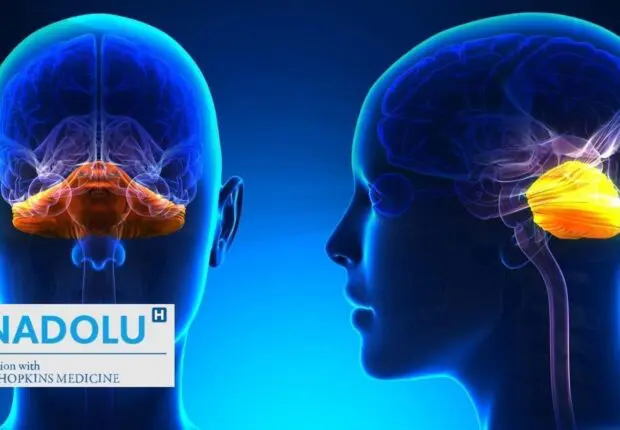 De la définition au traitement : tout savoir sur le syndrome cérébelleux (malformation de Chiari)