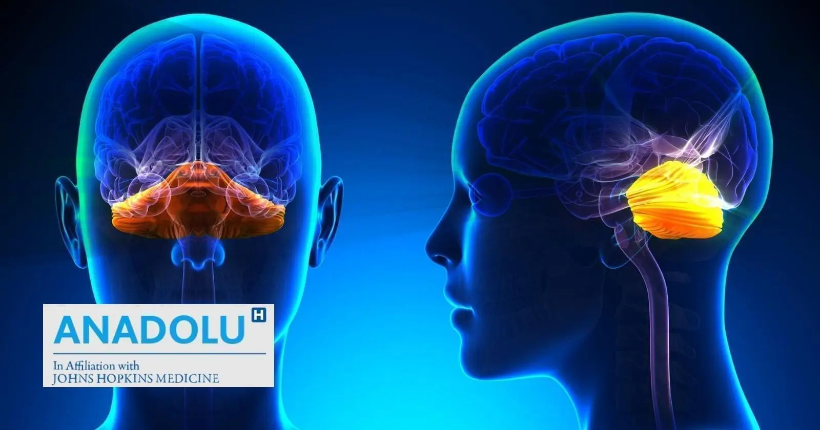 De la définition au traitement : tout savoir sur le syndrome cérébelleux (malformation de Chiari)