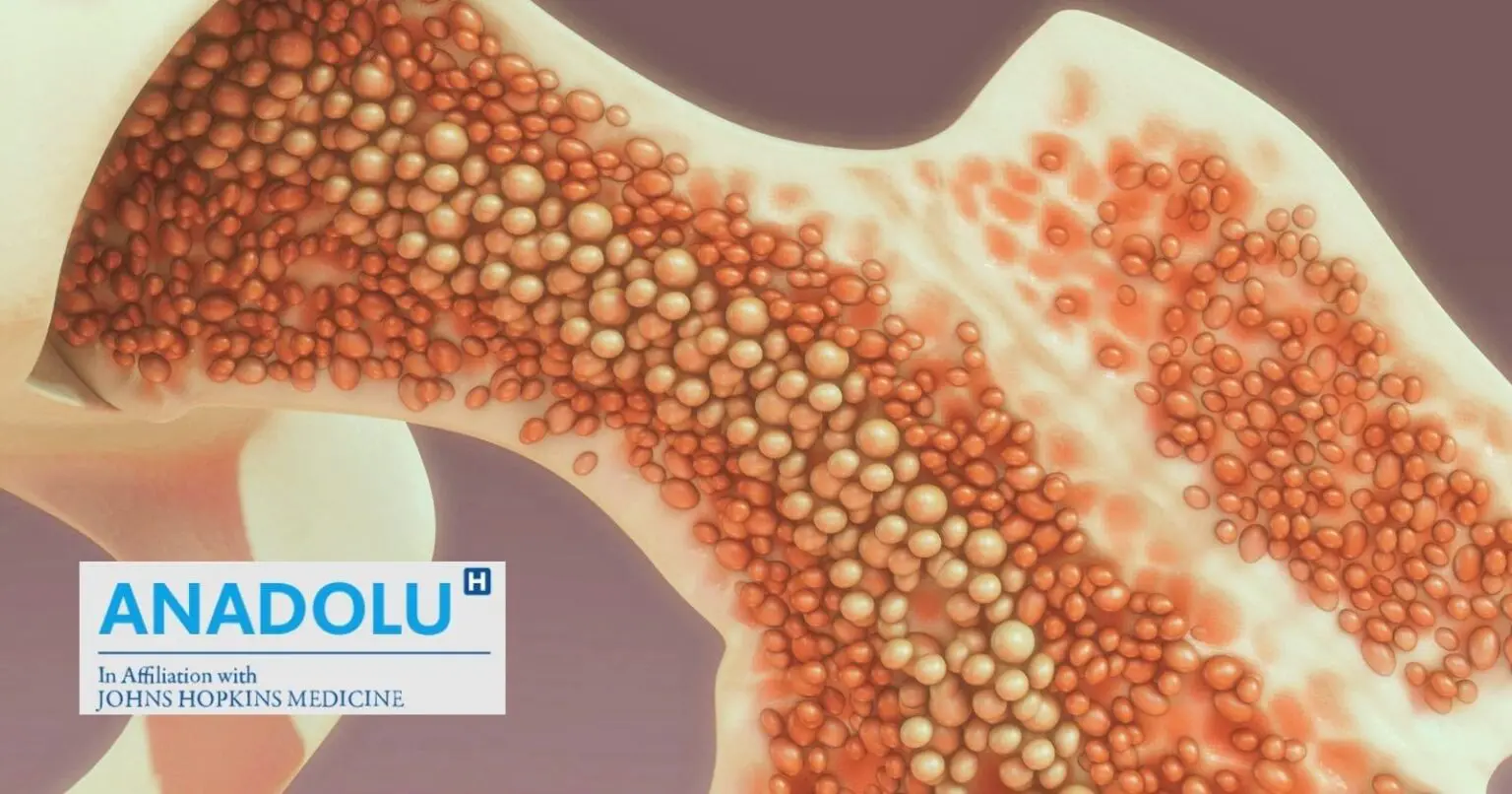 Myélome et leucémie : tout savoir sur les cancers de la moelle osseuse