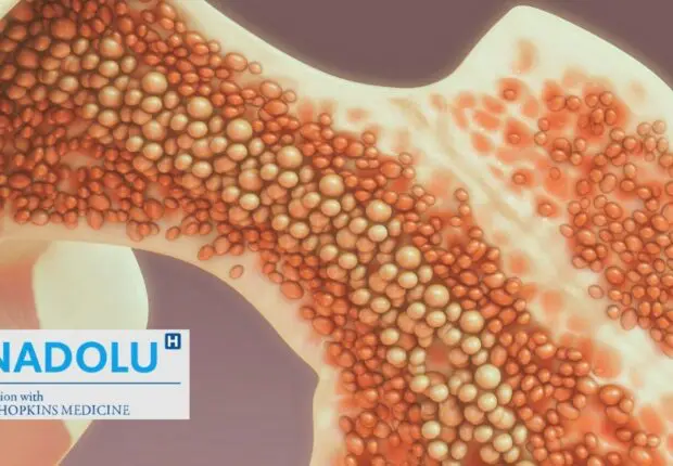 Myélome et leucémie : tout savoir sur les cancers de la moelle osseuse