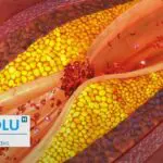 Quand nos vaisseaux sanguins durcissent : Tout savoir sur l&rsquo;athérosclérose