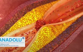 Quand nos vaisseaux sanguins durcissent : Tout savoir sur l&rsquo;athérosclérose