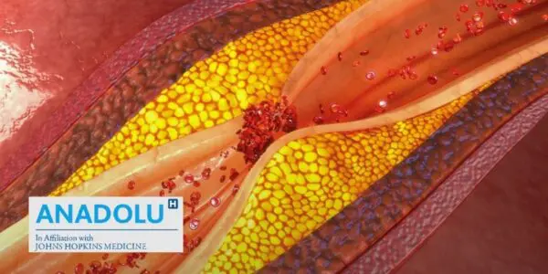 Quand nos vaisseaux sanguins durcissent : Tout savoir sur l’athérosclérose