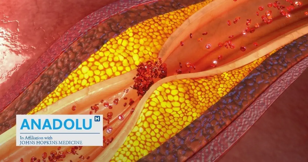 Quand nos vaisseaux sanguins durcissent : Tout savoir sur l’athérosclérose