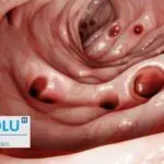 Diverticulite colique : causes, signes d&rsquo;alerte et traitements modernes