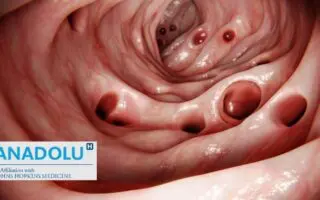 Diverticulite colique : causes, signes d&rsquo;alerte et traitements modernes