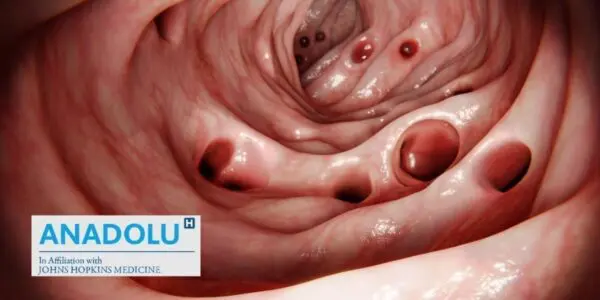 Diverticulite colique : causes, signes d&rsquo;alerte et traitements modernes