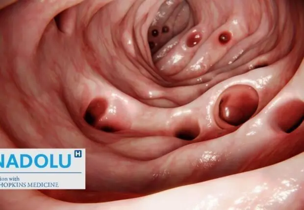 Diverticulite colique : causes, signes d’alerte et traitements modernes