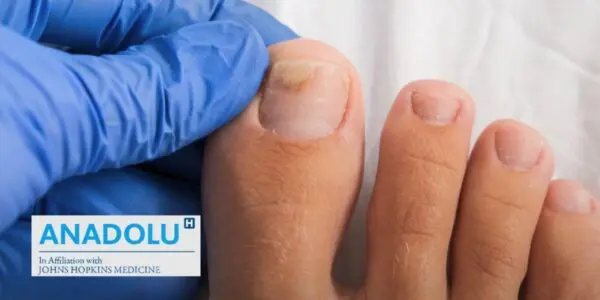 Ongles jaunes ou cassants : comprendre et soigner la mycose des ongles