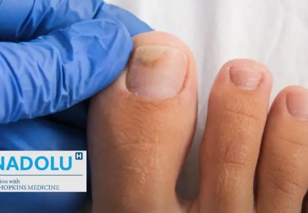 Ongles jaunes ou cassants : comprendre et soigner la mycose des ongles