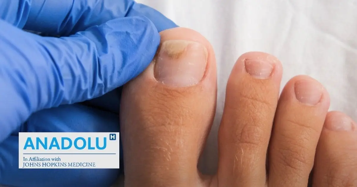 Ongles jaunes ou cassants : comprendre et soigner la mycose des ongles