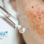 Hyperpigmentation de la peau : causes biologiques et solutions dermatologiques