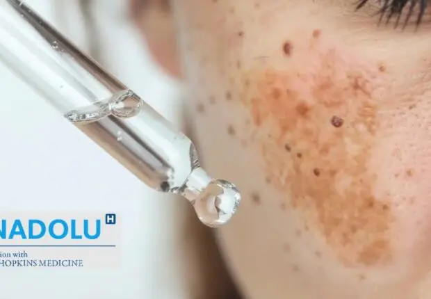 Hyperpigmentation de la peau : causes biologiques et solutions dermatologiques