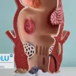 Saignement rectal : quelles en sont les causes réelles selon la science ?