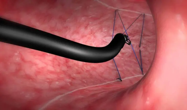 sleeve endoscopique