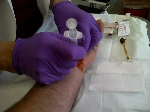 injection de cortisone dans le poignet.