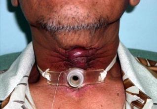 Algérie : L’incidence du cancer du larynx est de 4,4%