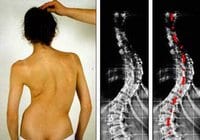 Scoliose idiopathique : Les enfants scoliotiques dans la détresse