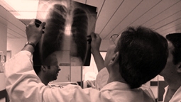 Le cancer du poumon peut avoir une prédisposition génétique