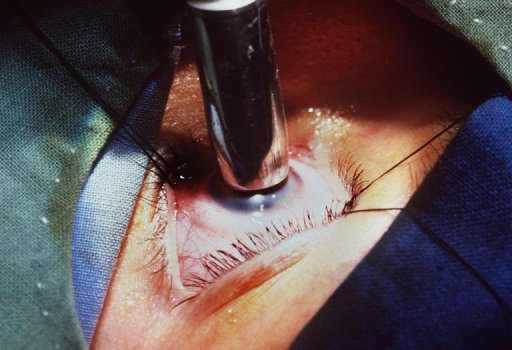 Des médecins italiens parviennent à restaurer la vue